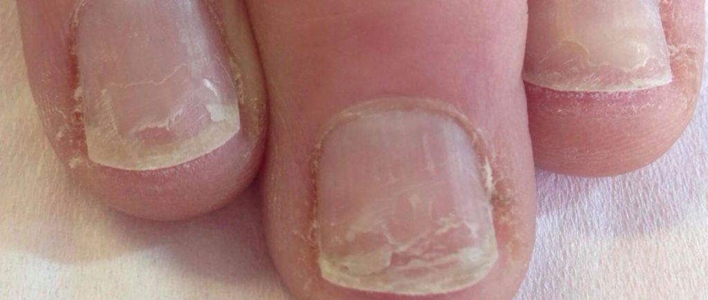lamellar dystrophy