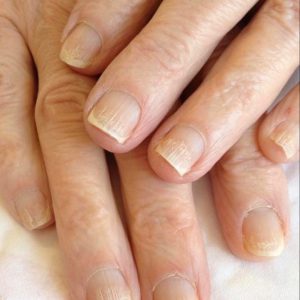 nail ridges