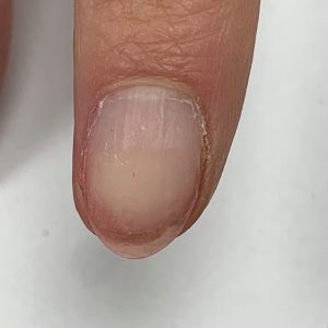 vertical nail ridges