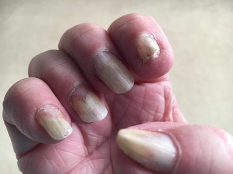 Onycholysis