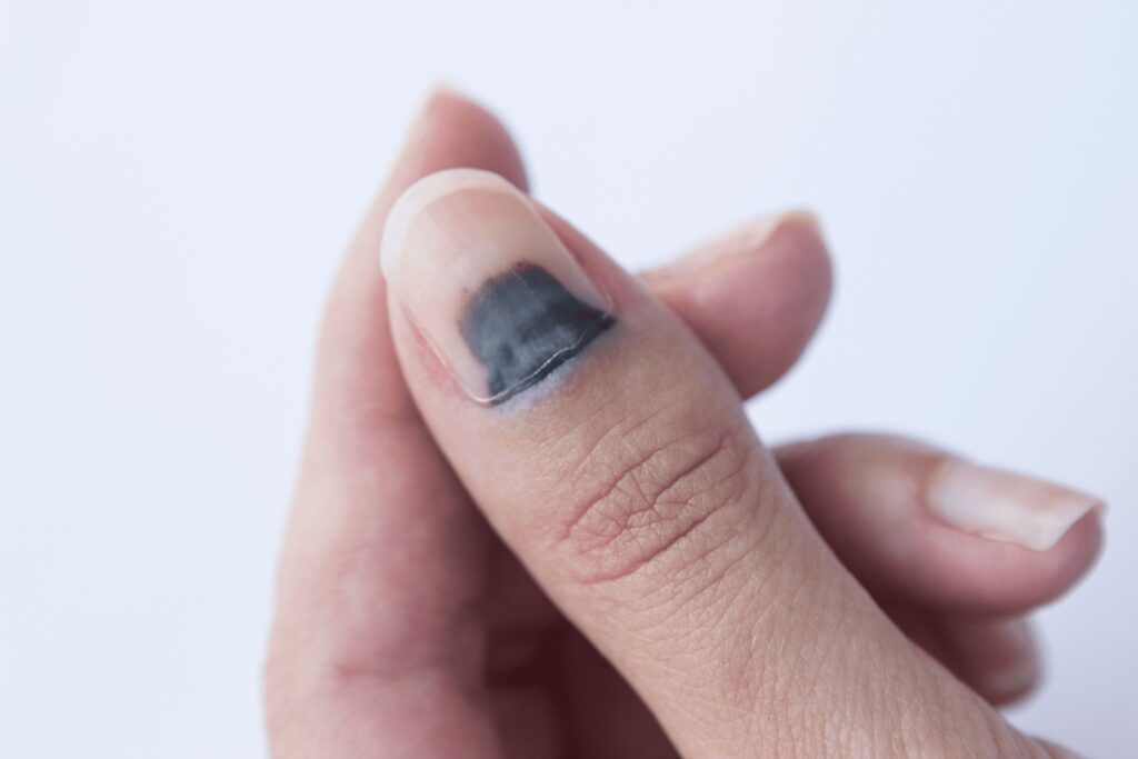 Bruised Nail
