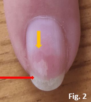 Psoriatic blister in the nail bed