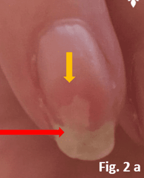 Psoriatic blister after it burst at the free edge