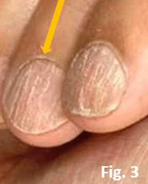 The roughness and groves of nail plates affected by Alopecia Areata