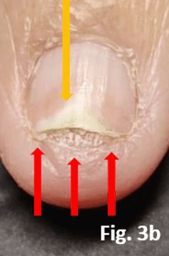 onycholysis and hyperkeratosis breaking the seal