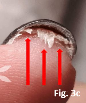 extreme hyperkeratosis underneath the free edge