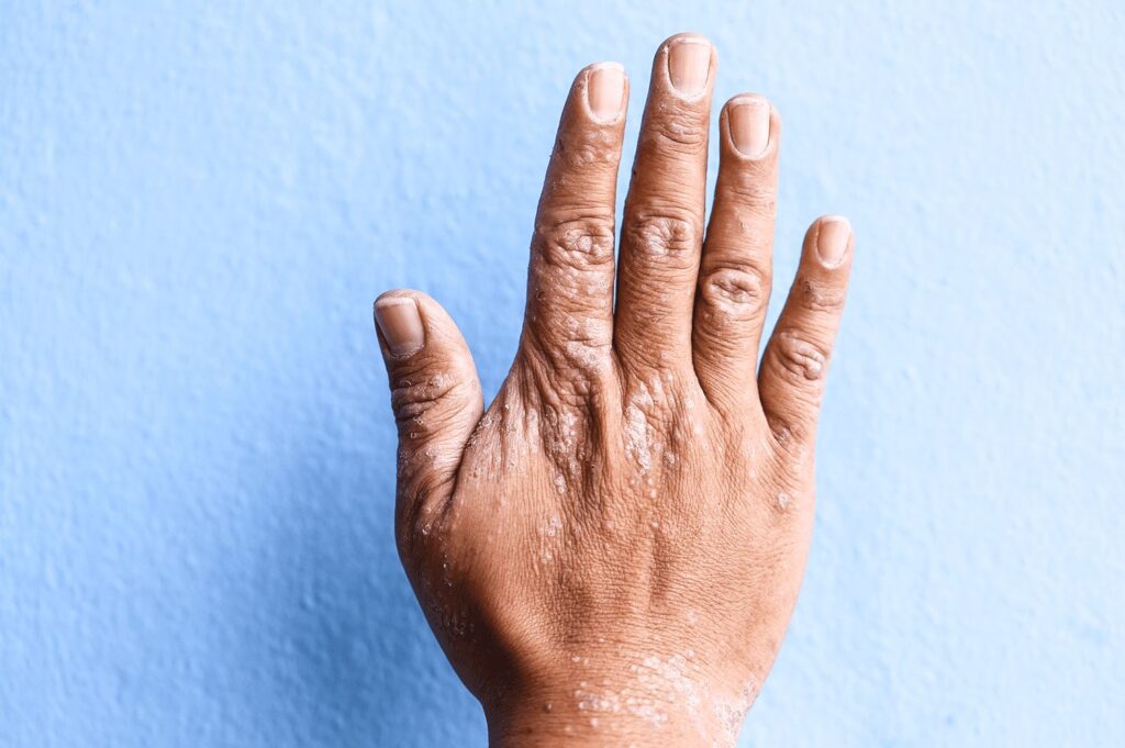 Dermatitis