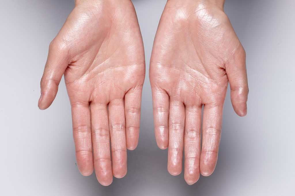 Hyperhidrosis