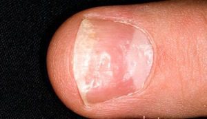 Nail Psoriasis