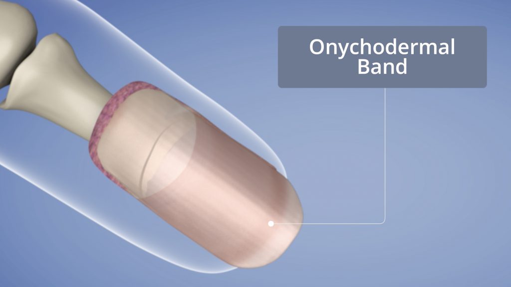 Onychodermal Band