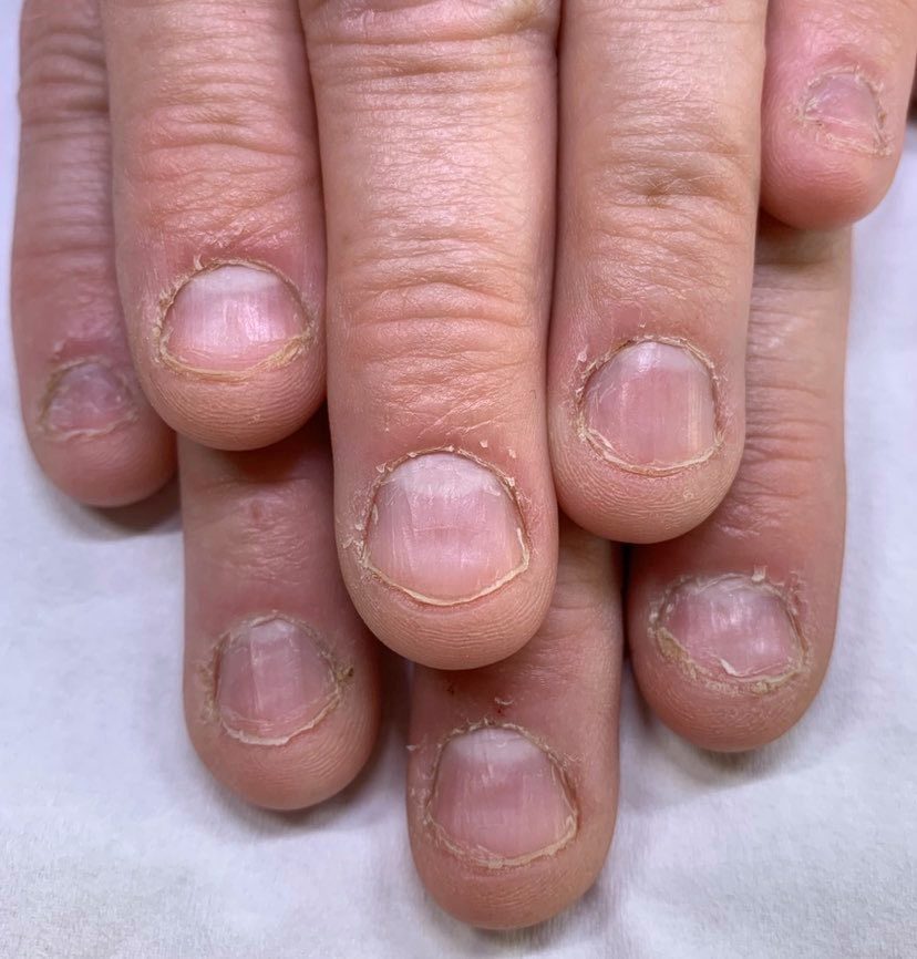Nail Biting - Onychophagia