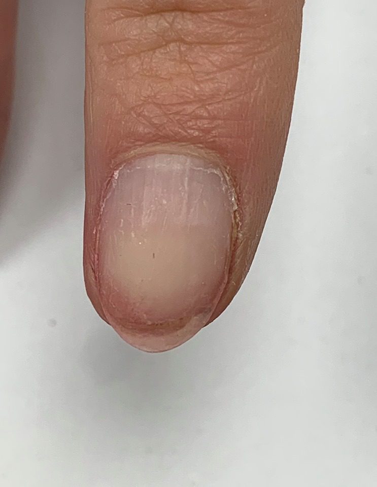 Crestas de las uñas