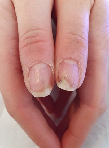 Onycholysis