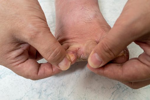 Tinea pedis