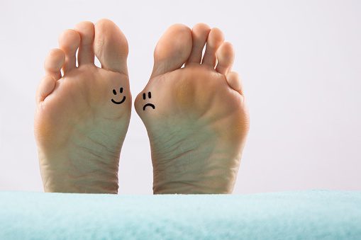 Hallux valgus, bunion