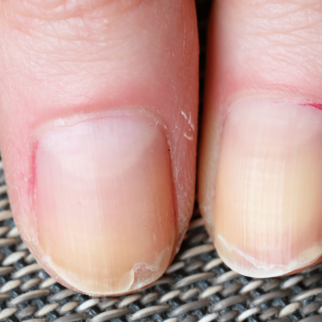 Nail delamination