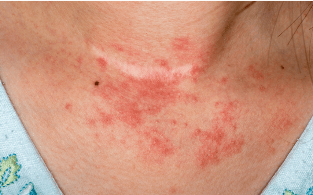 eczema