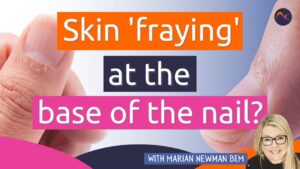 skin fraying nail
