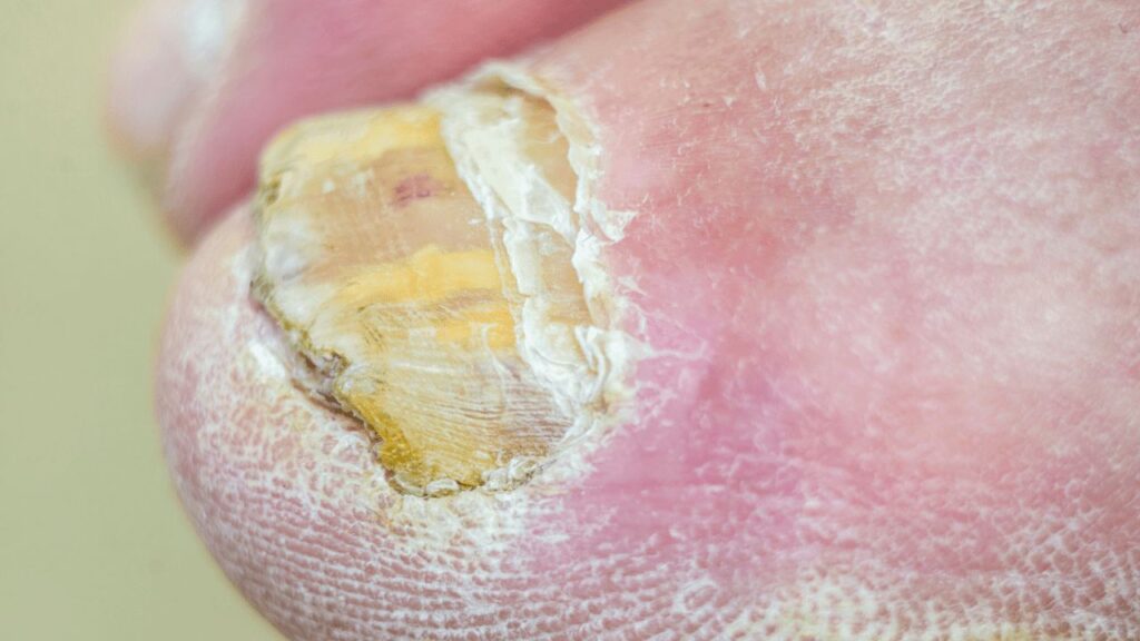 Yeast Infection nail