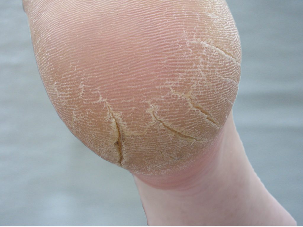 Callus on a heel