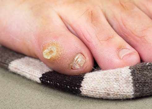 Corn on the side of little toe