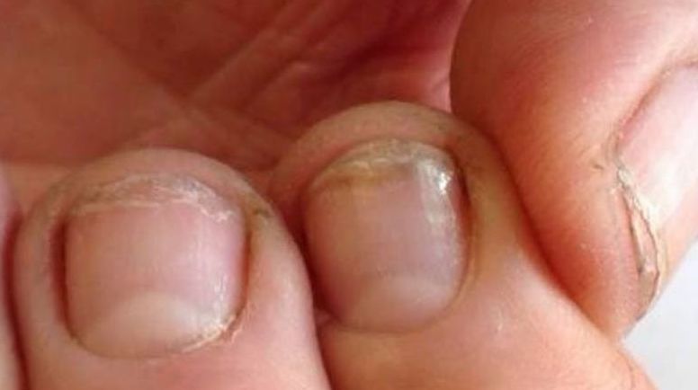 Lamellar Dystrophy