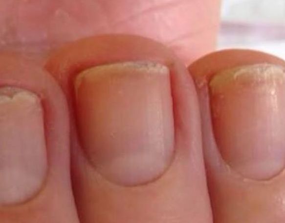 Lamellar Dystrophy
