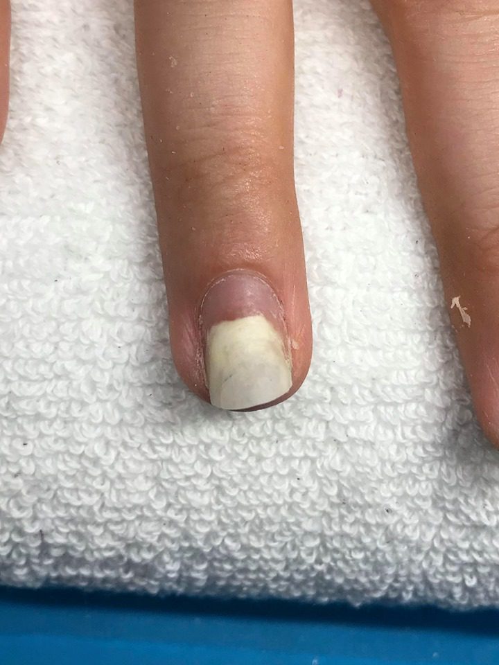 Onycholysis
