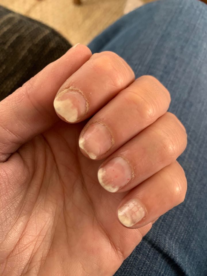 Onycholysis