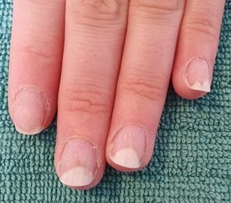 Onycholysis from nail coating