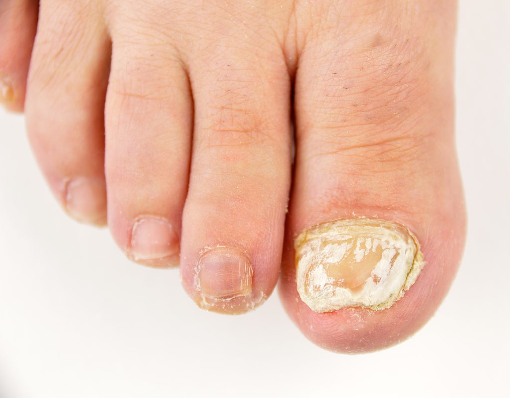 Onicomicosis superficial blanca WOS