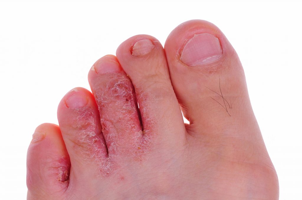 Tinea pedis, athlete's foot