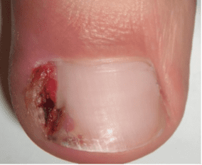 Ingrown-nail-unguis-incarnatus