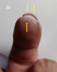 Nail file dust under free edge