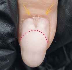 Heller Medial Nail Dystrophy