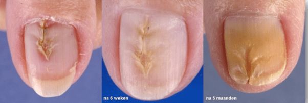 Recovery of a Heller's Median Nail Dystrophy