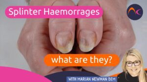 Nails Splinter Haemorrhage