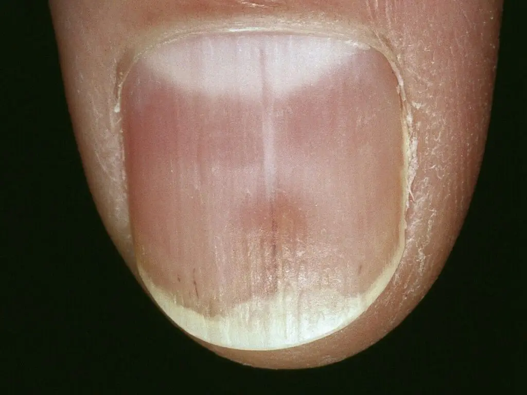 Erythronychia conditon explained