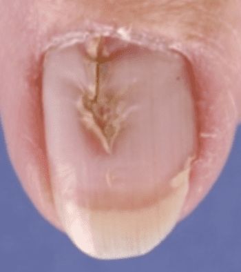 Heller’s Median Nail Dystrophy