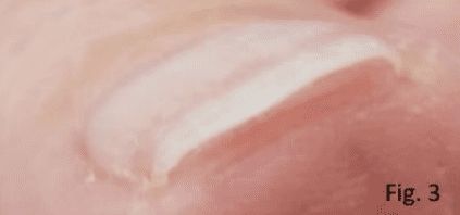 C Curve nail due to psoriasis