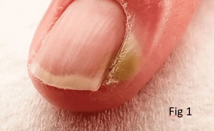 Paronychia infection in nail fold