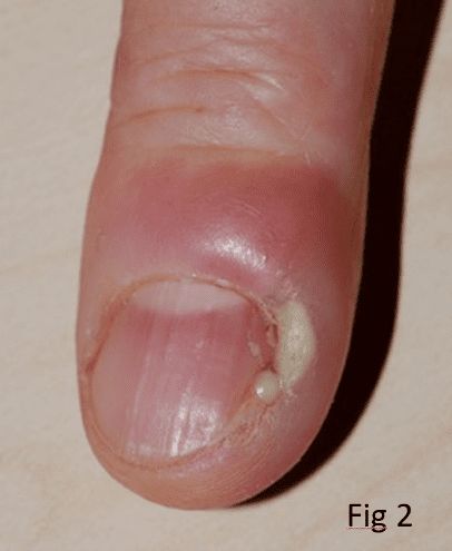 The red swelling is obvious & probably warm.