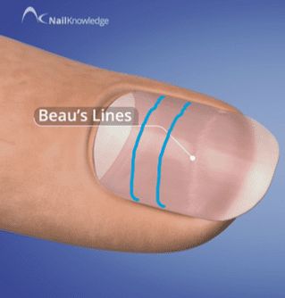 beau's line on a nail