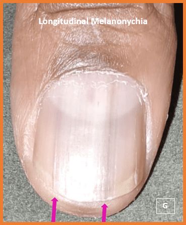 Longitudianl melanoma