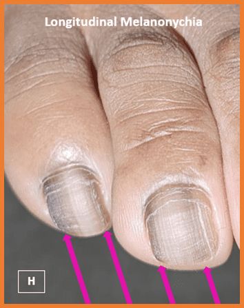 Nail Longitudianl melanoma