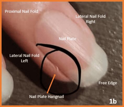 Nail Plate Hangnail