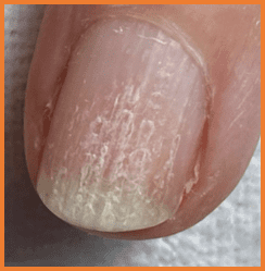 Nail beads in the nail plate