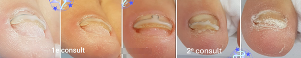 nail plate correction techniques