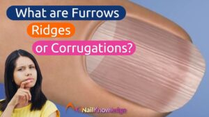 Nail Furrows, Ridges or Corrugations