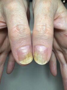 long-standing onycholysis (nail separation).